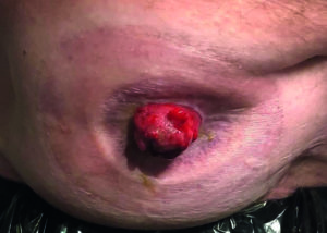 stoma