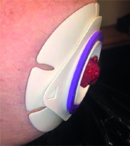 stoma mit eakin dot 2-delig soft convex